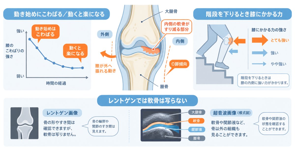 歩き始めのこわばりや階段でカクンと抜ける感覚は初期症状のサインか