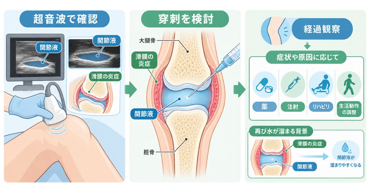 膝に水が溜まる時の治療法、抜く処置の判断基準と原因へのアプローチ